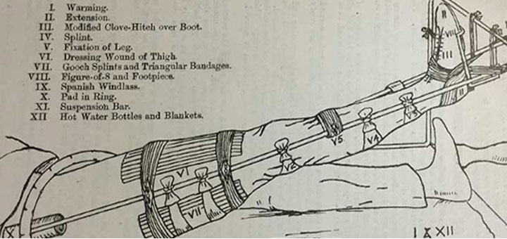 The Thomas Splint: A revolution in treatment